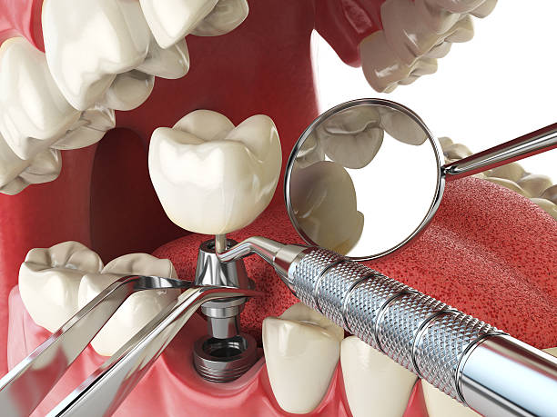 Best Emergency Root Canal Treatment in Grand Haven, MI